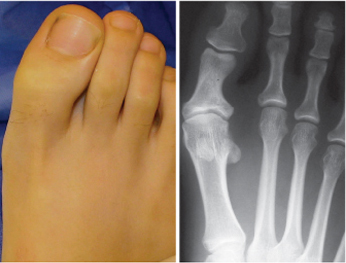 inflamația articulației pe picior în apropierea degetului mare