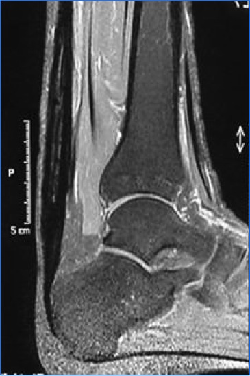 Aspect RMN de tendinita ahileană noninserțională