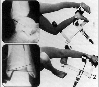 tendință și afecțiuni ale gleznei ligamentare)