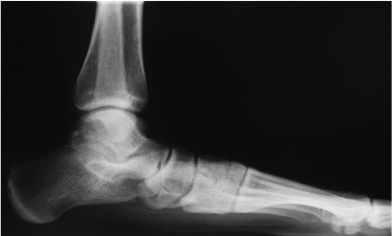 Radiografie în sprijin a piciorului