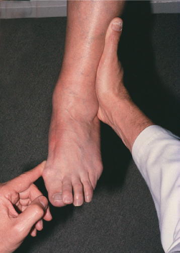 Examen clinic picior plat