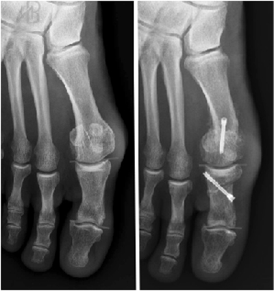 Aspect radiologic pre- și postoperator - osteotomii tip Chevron și Akin pentru corecția hallux valgus