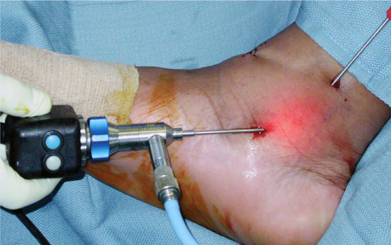 Refacerea cartilajului în articulația gleznei