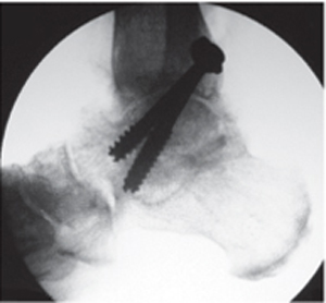 Artrodeza restaurării articulației gleznei, Artroscopia și endoscopia gleznei și piciorului
