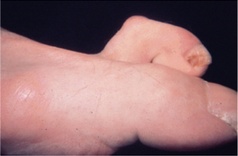 Artrita reumatoidă deformarea degetelor de la nivelul picioarelor