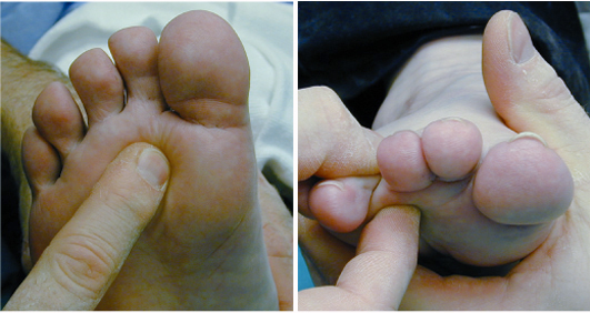 tratamentul ligamentelor cruciate ale genunchiului unguente pentru îmbinări cu piper
