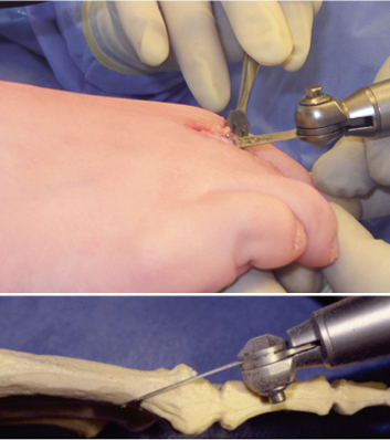 tratamentul osteoartritei cotului